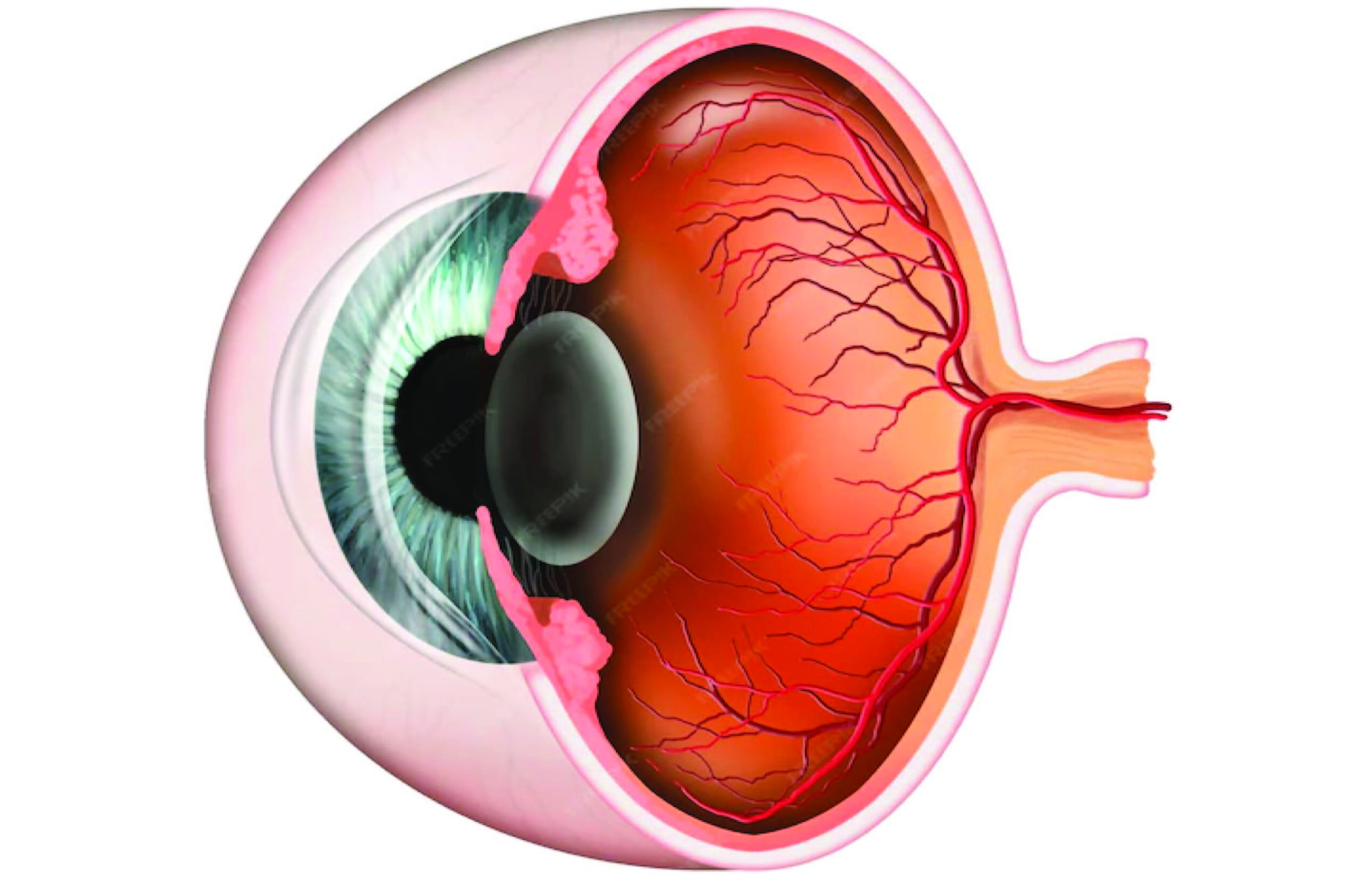 Corneal Transplant