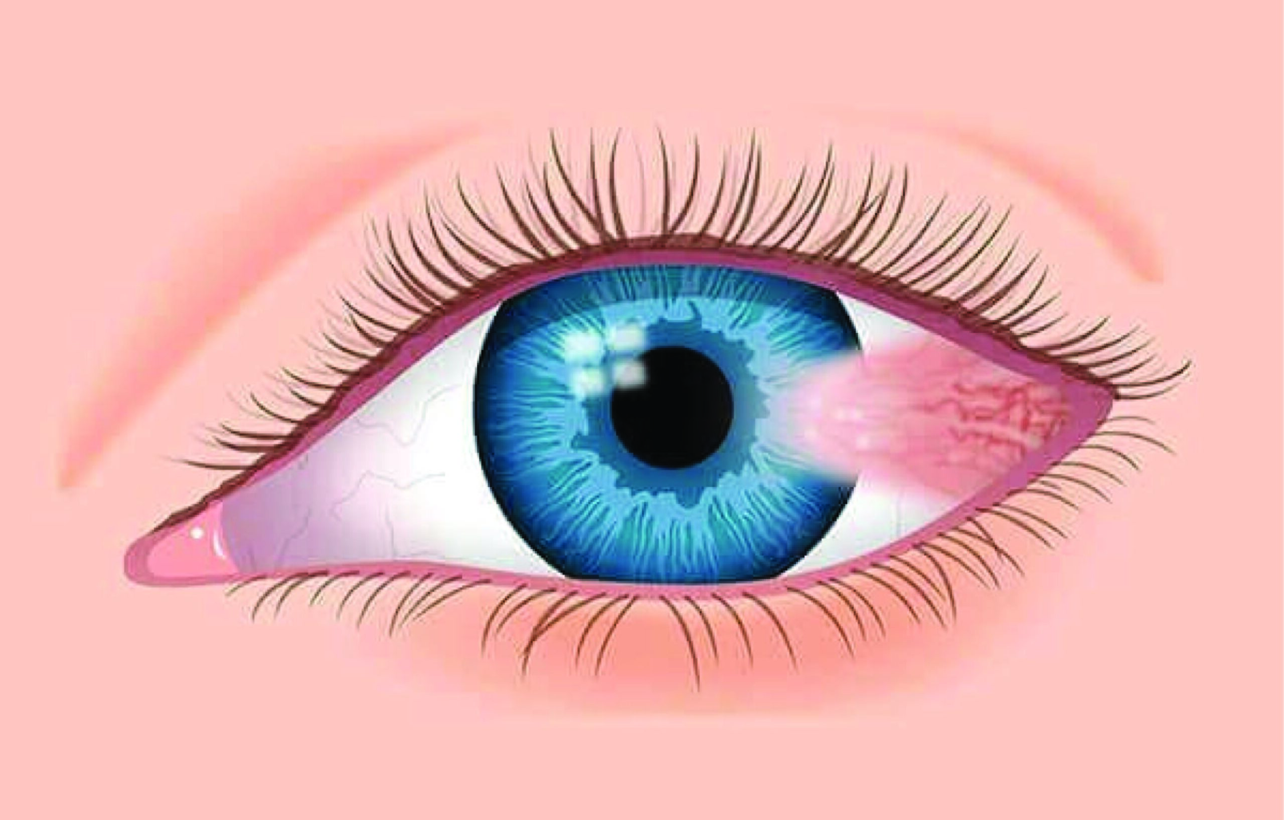 Pterygium Surgery